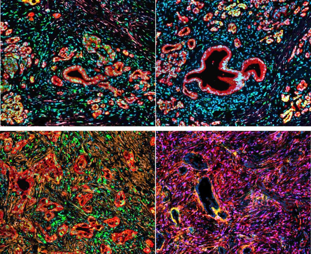 Vier nebeneinander angeordnete mikroskopische Aufnahmen (2×2-Layout) zeigen Gewebestrukturen in fluoreszierender Färbung. Die Bilder sind dunkel hinterlegt und von intensiven Farben durchzogen: leuchtendes Rot, Grün, Blau und teils Gelb markieren unterschiedliche Zelltypen und Strukturen. Oben links sind zahlreiche kleine, rundliche bis schlauchförmige Strukturen in Rot zu sehen, eingebettet in ein dichtes Netz aus blau-grünen Punkten und faserartigen Linien. Oben rechts hebt sich eine größere, unregelmäßig geformte, rot umrandete Struktur mit dunklem Inneren deutlich ab, umgeben von vielen kleineren, ähnlich gefärbten Elementen. Unten links wirkt das Gewebe dichter und unruhiger: viele rote, längliche Zellverbände liegen zwischen braun-orangefarbenen faserigen Strukturen und grünen Signalen. Unten rechts dominieren kräftige Magenta- und Violetttöne, die ein wirbelartiges Muster bilden, durchzogen von dunklen Hohlräumen und einzelnen gelblichen Akzenten. Insgesamt vermitteln die Bilder einen wissenschaftlichen Blick auf komplexe Gewebearchitektur mit stark kontrastierenden, fluoreszierend markierten Zellbestandteilen.