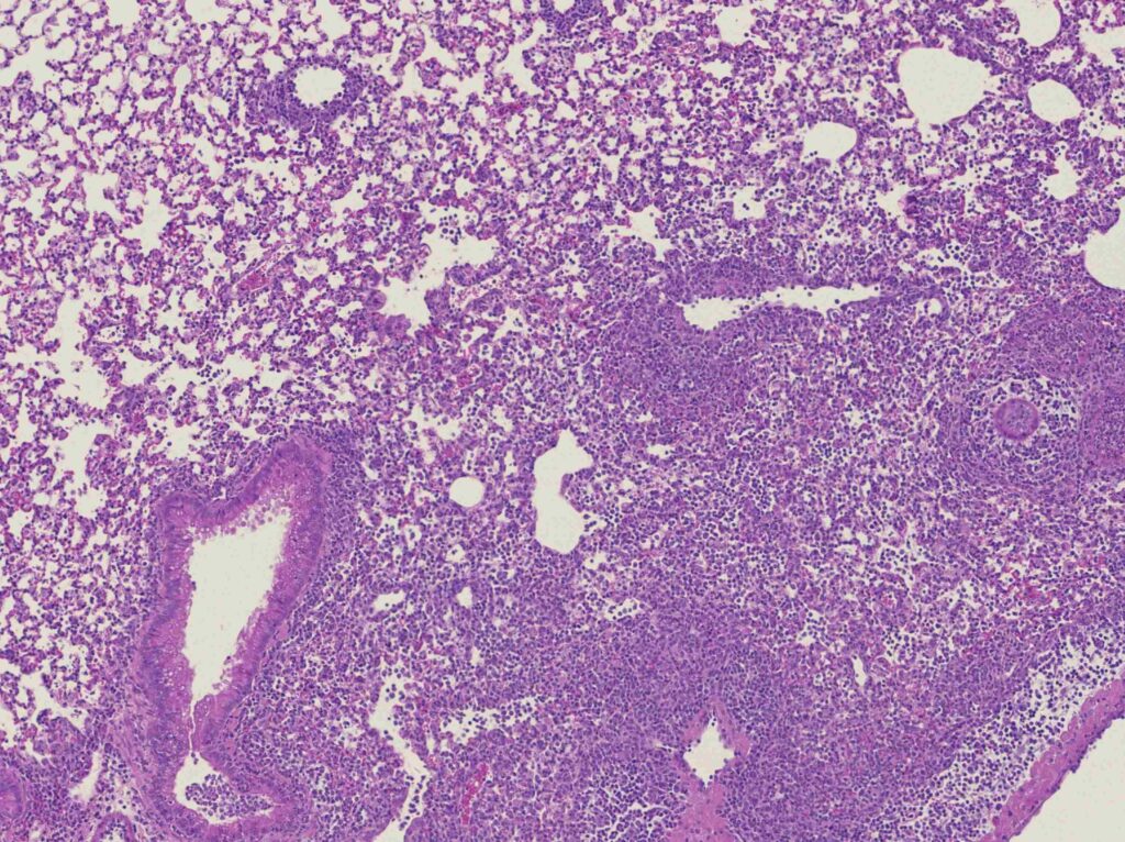 Mikroskopische Aufnahme von entzündetem Lungengewebe. Zu sehen sind violett und rosa gefärbte Gewebestrukturen mit zahlreichen dicht angeordneten Entzündungszellen rund um die Atemwege und in den angrenzenden Lungenbereichen.